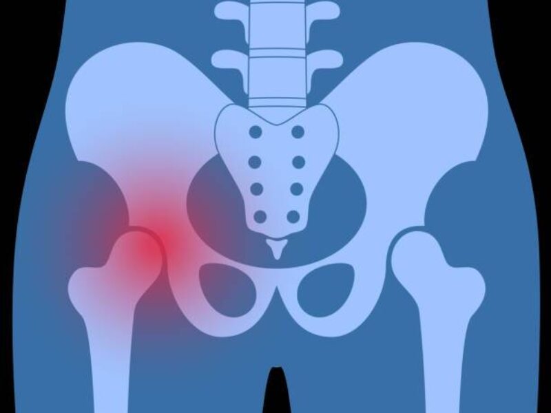 FAI（股関節インピンジメント）